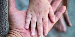 সিলেটে হামের উপসর্গে আরও ২ শিশুর মৃ*ত্যু