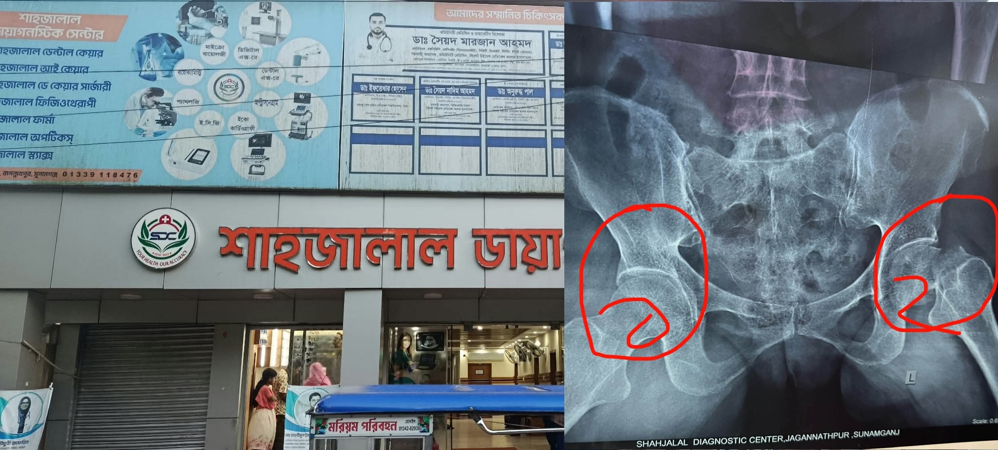 ভুল চিকিৎসায় পঙ্গুত্বের ঝুঁকিতে নারী, সিলেটে অস্ত্রোপচারের প্রস্তুতি