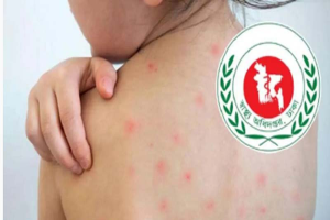 হাম ও হামের উপসর্গ নিয়ে আরও ৫ জনের মৃ ত্যু