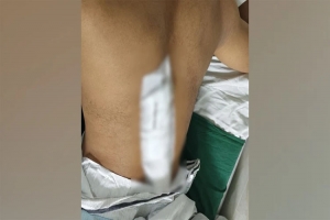 রাজধানীতে ইমিগ্রেশন পুলিশের এসআইকে কু পি য়ে জ খ ম, পিঠে ৪৩ সেলাই রাজধানীতে ইমিগ্রেশন পুলিশের এসআইকে কু পি য়ে জ খ ম, পিঠে ৪৩ সেলাই