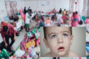 সিলেটে হামের প্রকো*প:  আরও দুই শিশুর মৃ*ত্যু,